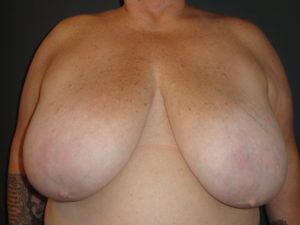 Scottsdale Breast Reduction Before Photos #4715