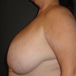 Scottsdale Breast Reduction Before Photos #4715