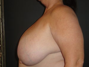 Scottsdale Breast Reduction Before Photos #4715