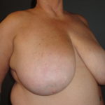 Scottsdale Breast Reduction Before Photos #4715