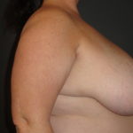 Scottsdale Breast Reduction Before Photos #4715