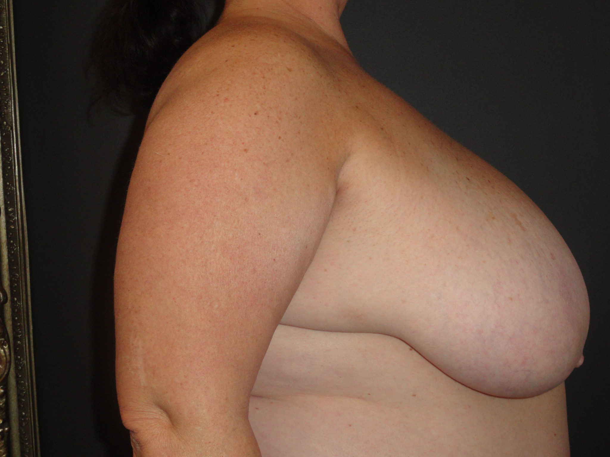 Scottsdale Breast Reduction Before Photos #4715
