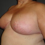 Scottsdale Breast Reduction After Photos #4715