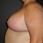 Scottsdale Breast Reduction After Photos #4715