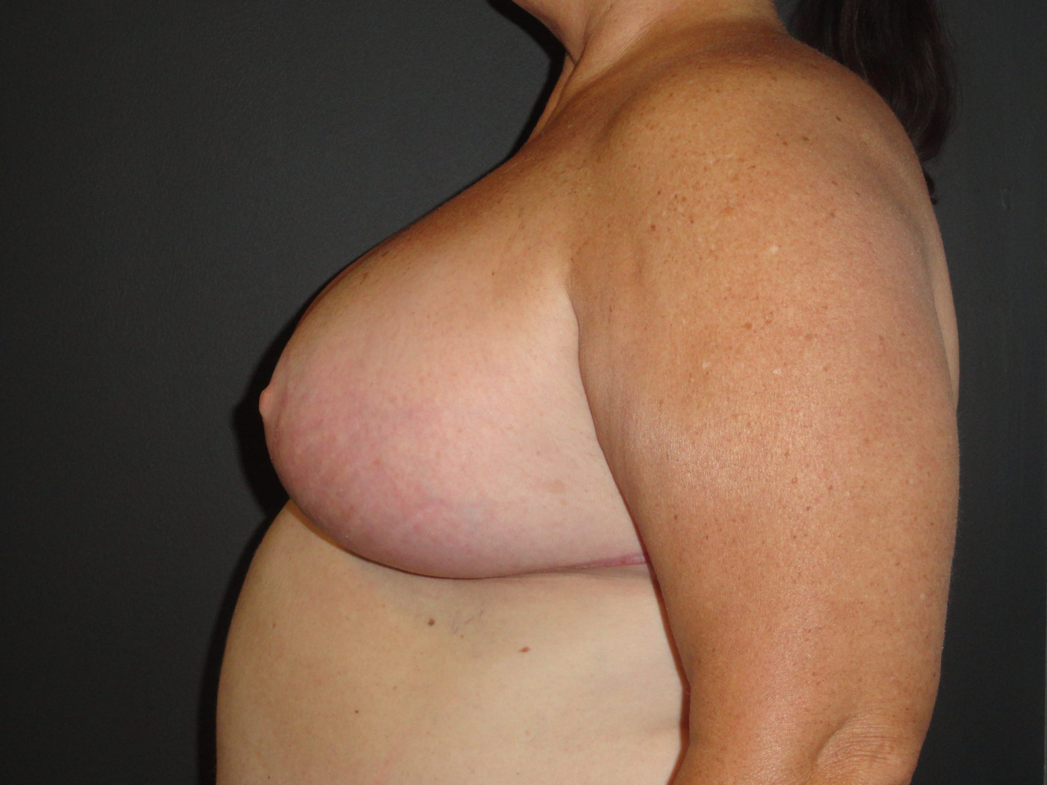 Scottsdale Breast Reduction After Photos #4715