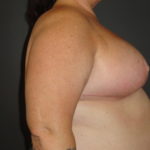 Scottsdale Breast Reduction After Photos #4715