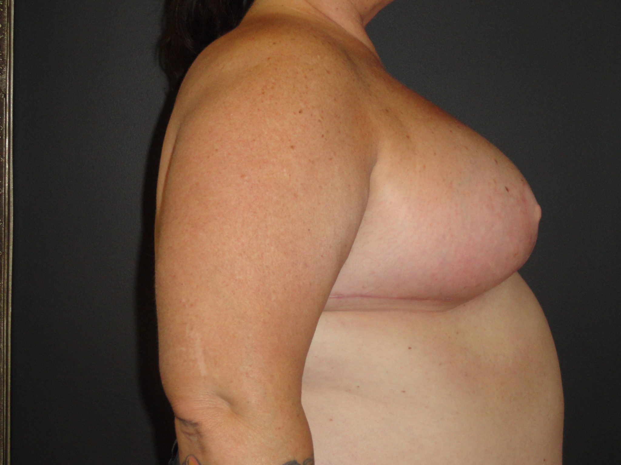 Scottsdale Breast Reduction After Photos #4715