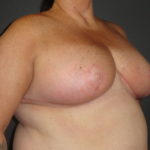 Scottsdale Breast Reduction After Photos #4715