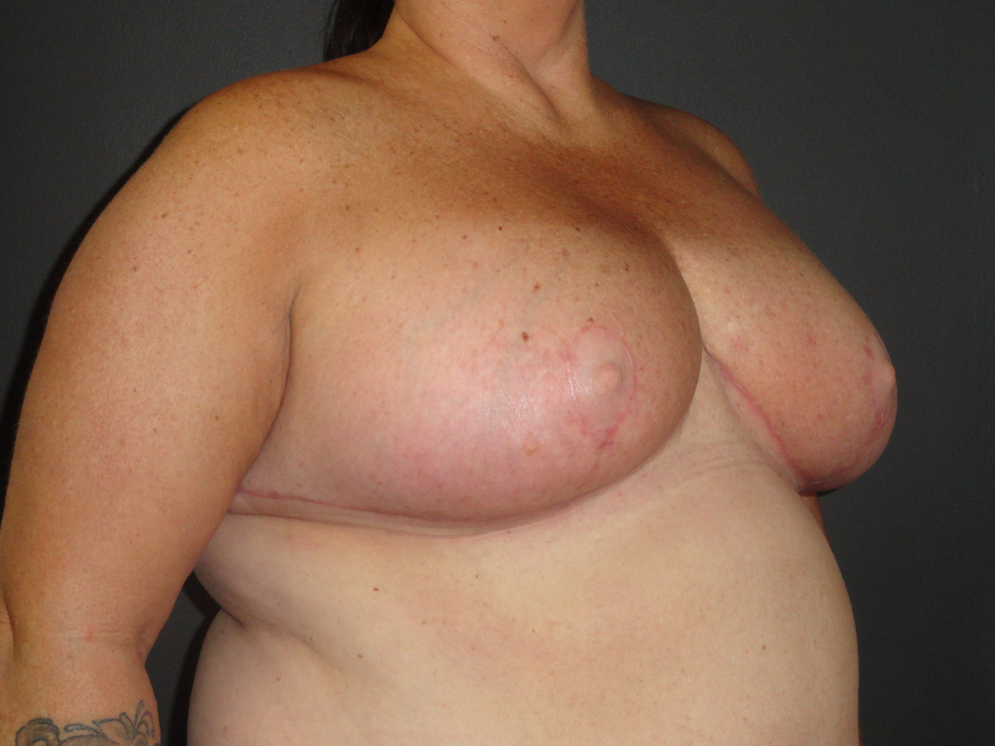 Scottsdale Breast Reduction After Photos #4715