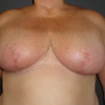 Scottsdale Breast Reduction After Photos #4715