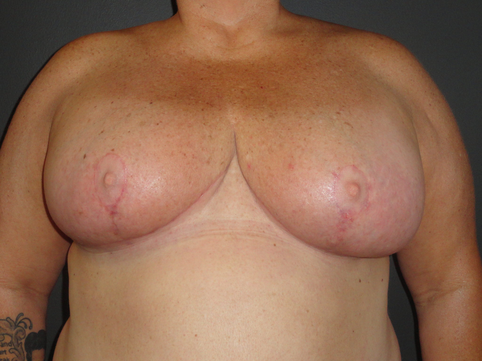 Scottsdale Breast Reduction After Photos #4715