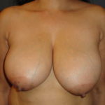 Breast Reduction in Scottsdale Arizona Before Photos