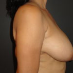 Breast Reduction in Scottsdale Arizona Before Photos