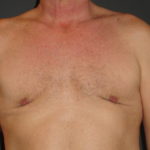 Gynecomastia Surgery Before and After Photo