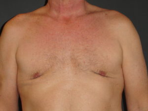 Gynecomastia Surgery Before and After Photo