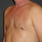 Gynecomastia Surgery Before and After Photo