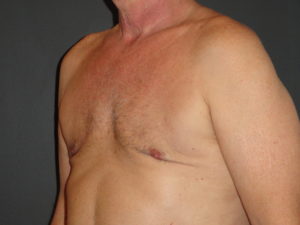 Gynecomastia Surgery Before and After Photo