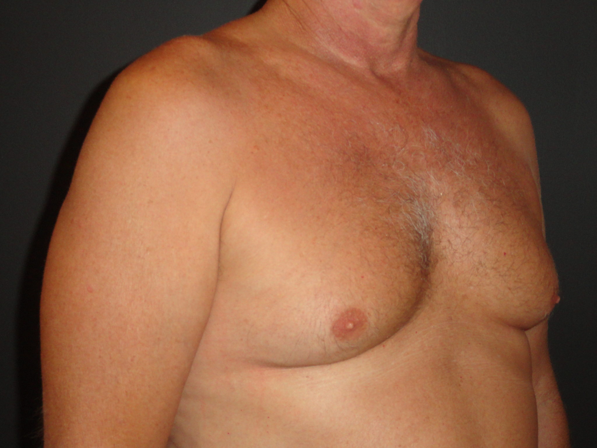 Gynecomastia Surgery Before and After Photos