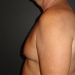 Gynecomastia Surgery Before and After Photos