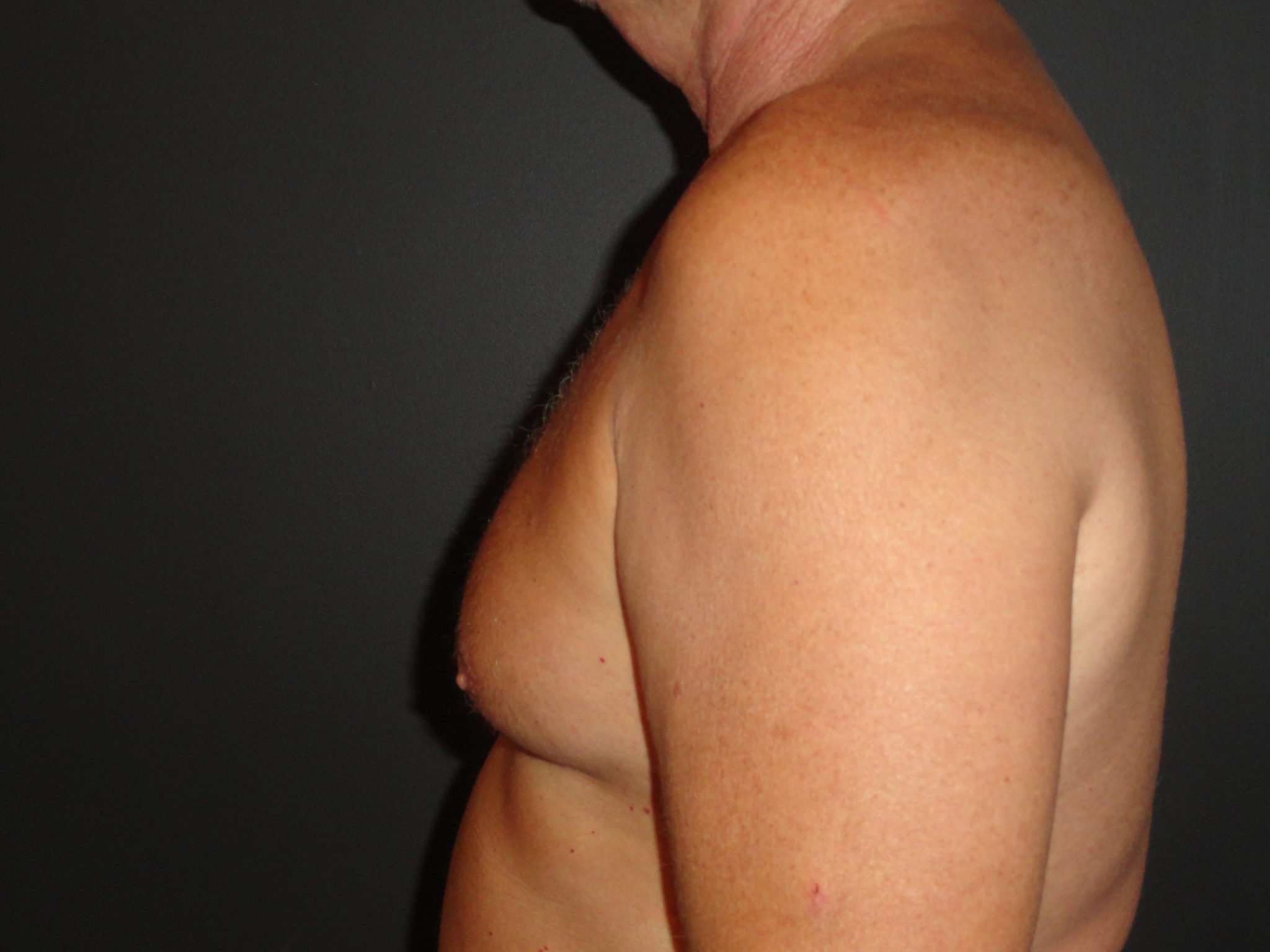 Gynecomastia Surgery Before and After Photos