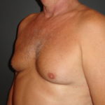 Gynecomastia Surgery Before and After Photos