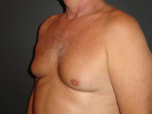 Gynecomastia Surgery Before and After Photos