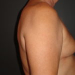 Gynecomastia Surgery Before and After Photo