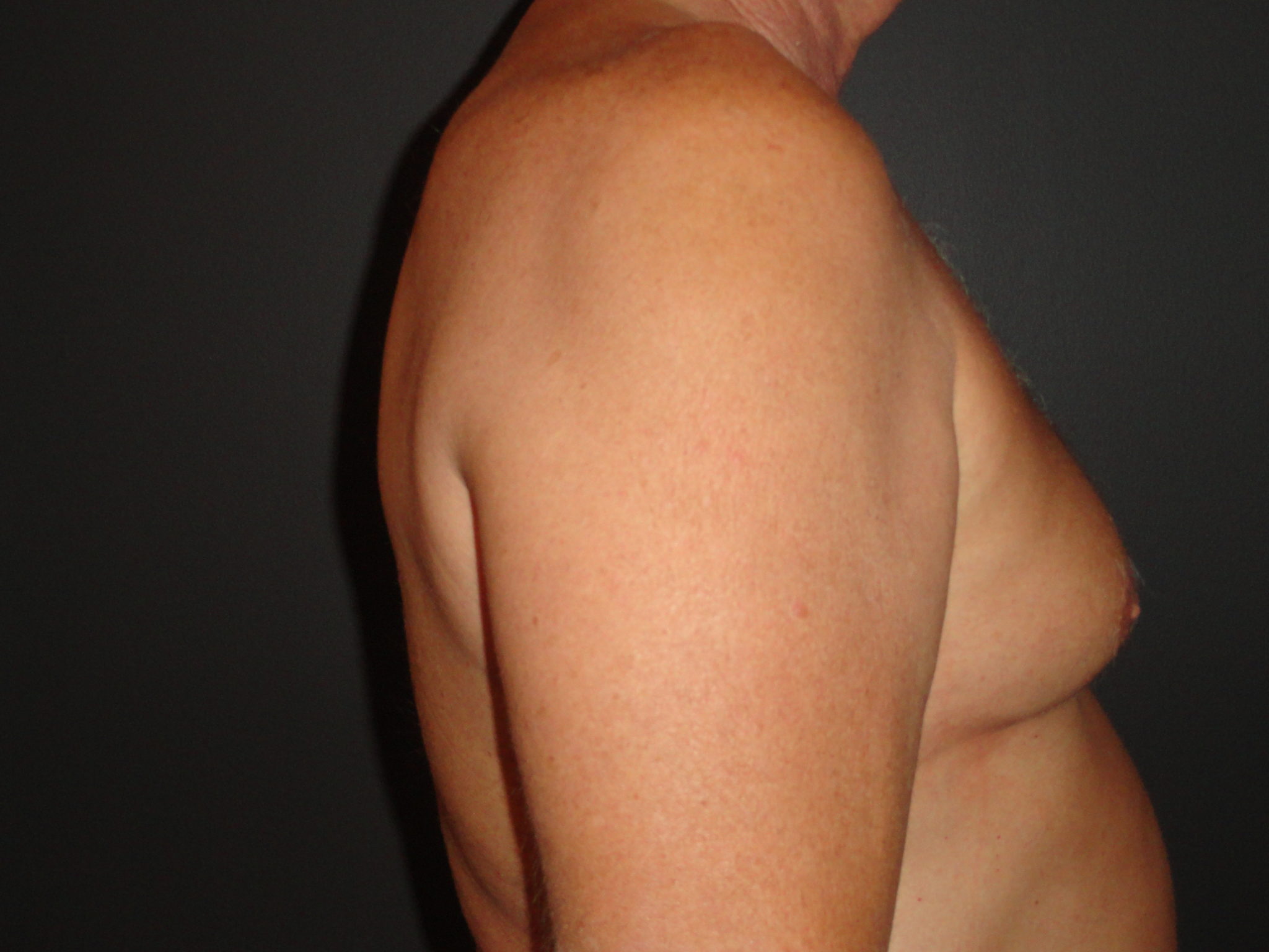 Gynecomastia Surgery Before and After Photo