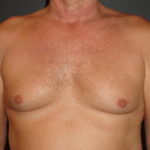 Gynecomastia Surgery Before and After Photos