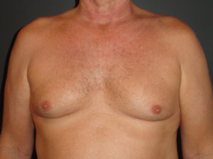 Gynecomastia Surgery Before and After Photos