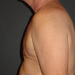 Gynecomastia Surgery Before and After Photos