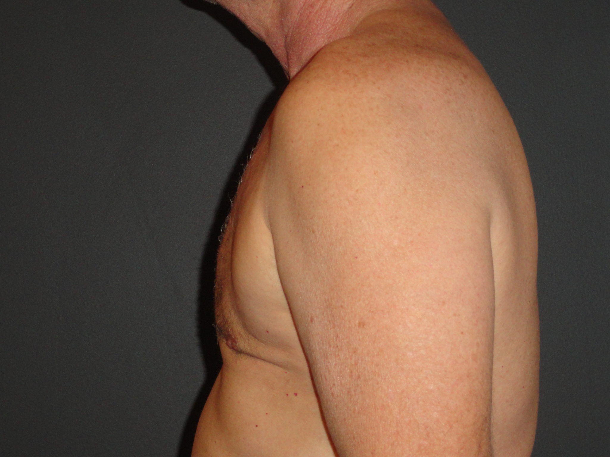 Gynecomastia Surgery Before and After Photos