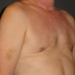 Gynecomastia Surgery Before and After Photo