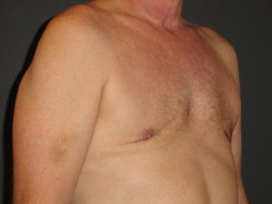 Gynecomastia Surgery Before and After Photo