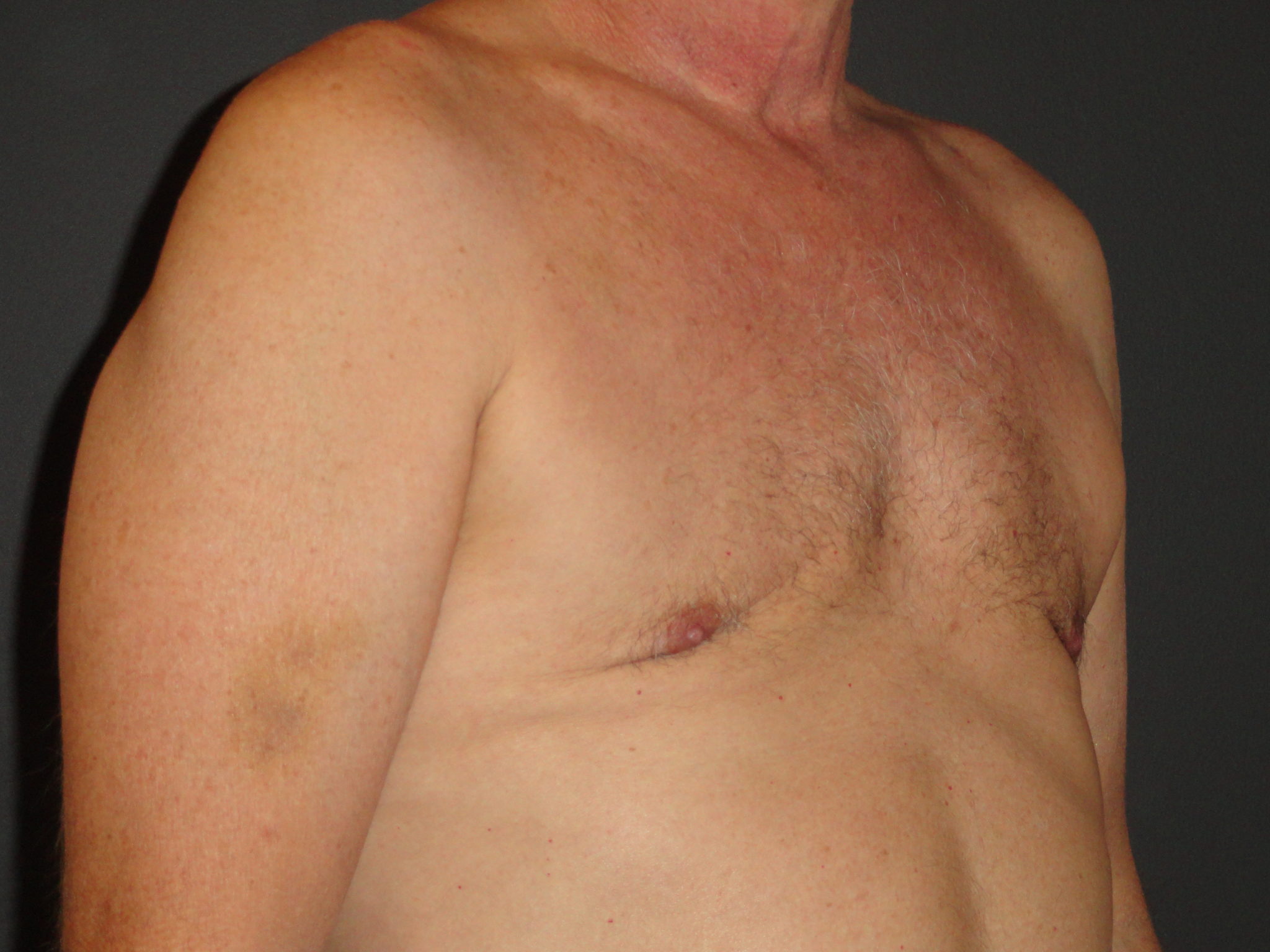 Gynecomastia Surgery Before and After Photo