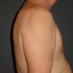 Gynecomastia Surgery Before and After Photo