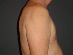 Gynecomastia Surgery Before and After Photo