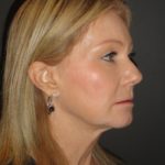 Laser Resurfacing Scottsdale Case 1 After Photos