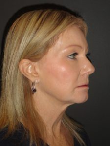 Laser Resurfacing Scottsdale Case 1 After Photos