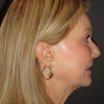 Laser Resurfacing Scottsdale Case 1 After Photos