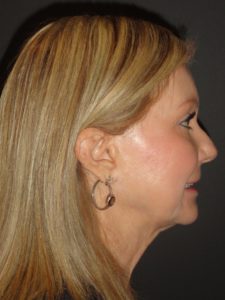 Laser Resurfacing Scottsdale Case 1 After Photos