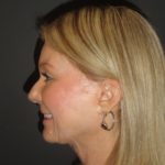 Laser Resurfacing Scottsdale Case 1 After Photos