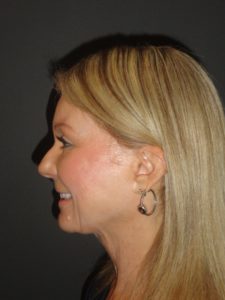 Laser Resurfacing Scottsdale Case 1 After Photos