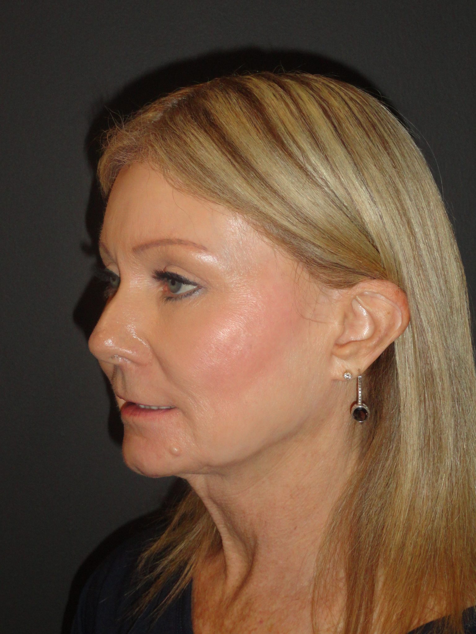 Laser Resurfacing Scottsdale Case 1 After Photos