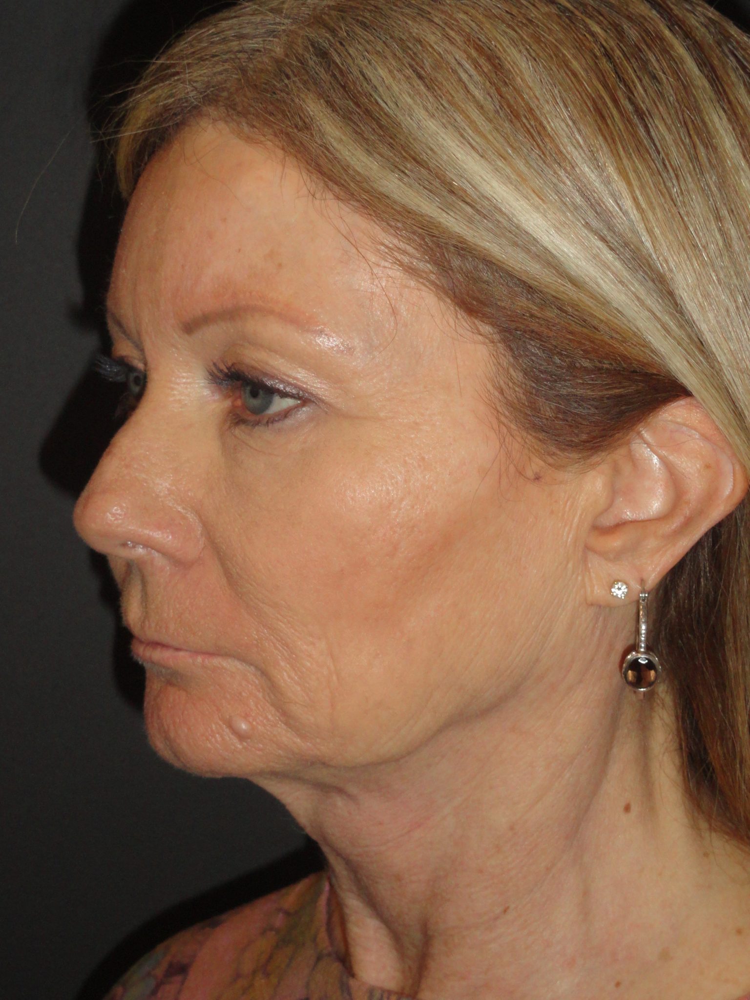 Laser Resurfacing Scottsdale Case 1 Before Photos