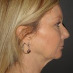 Laser Resurfacing Scottsdale Case 1 Before Photos