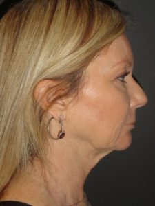 Laser Resurfacing Scottsdale Case 1 Before Photos