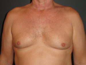 Gynecomastia surgery Scottsdale