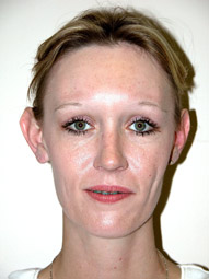 Otoplasty Scottsdale Before Photos Case 2