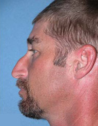 Rhinoplasty Before And After Photo